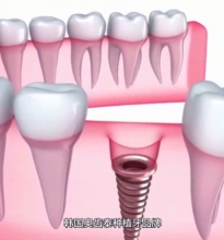种植体排名前十（下），选择适合你的植体很重要！